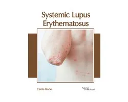 Systemic Lupus Erythematosus