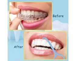 Aligner Remover Tool – Beugel Verwijder tool voor Clear Aligners – Geschikt voor invisalign - Hygienisch en Herbruikbaar - 1 stuk
