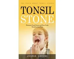 Tonsil Stones