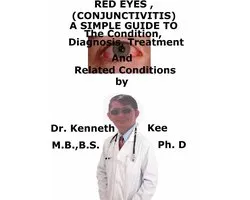 Red Eyes (Conjunctivitis), A Simple Guide To The Condition, Diagnosis, Treatment And Related Conditions